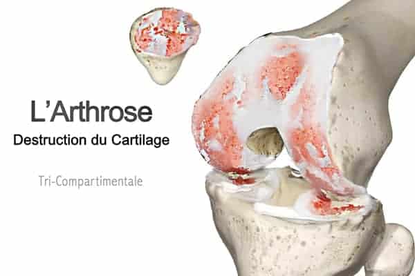 Gonarthrose (arthrose du genou) 